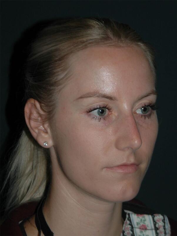 Non Surgical Rhinoplasty Before & After Photo