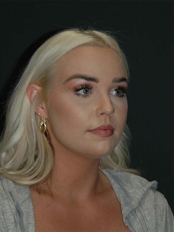 Jawline Contouring Before & After