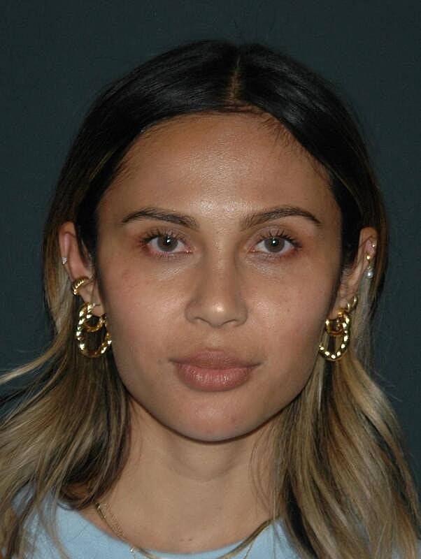 Jawline Contouring Before & After