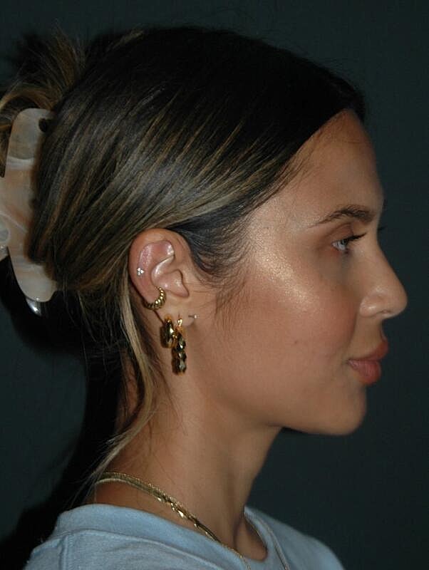 Jawline Contouring Before & After