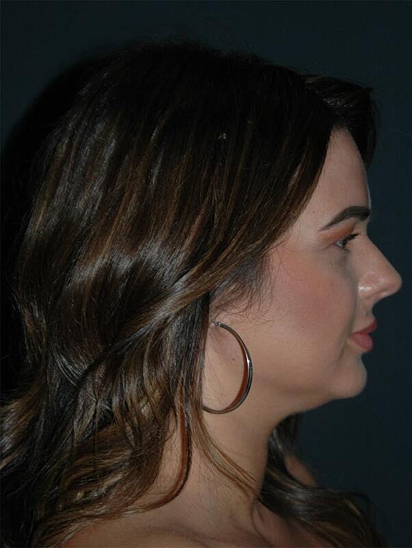 Jawline Contouring Before & After