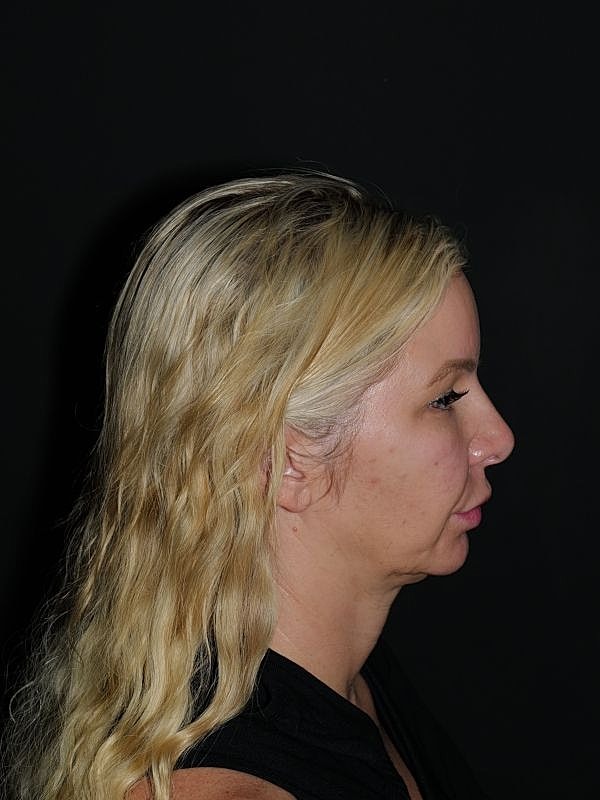 Fat Transfer Before & After