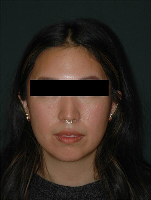 Chin Implant Before & After