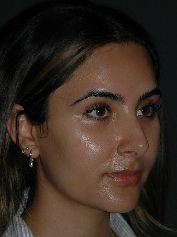 Tear Trough Filler Before & After