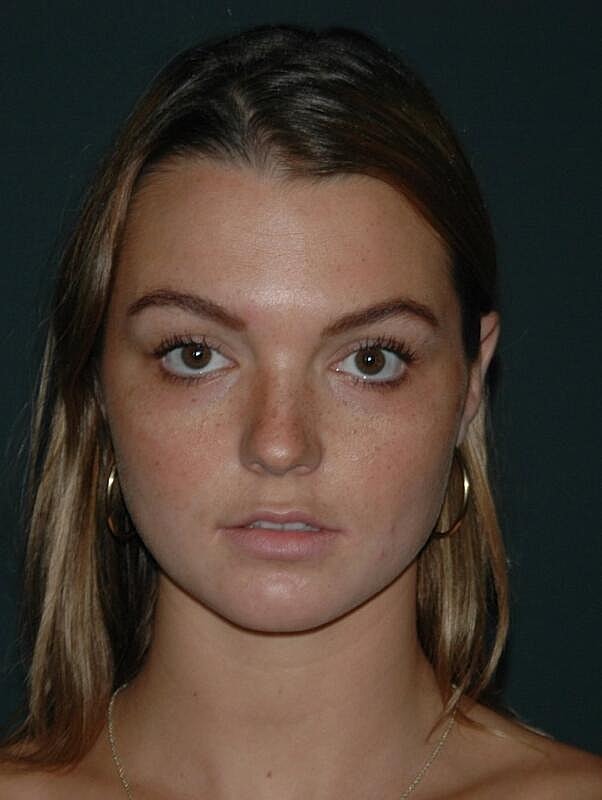 Tear Trough Filler Before & After