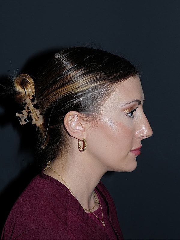 Rhinoplasty Before & After
