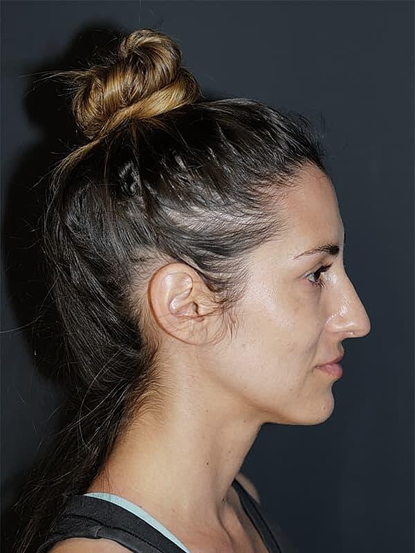 Rhinoplasty Before & After