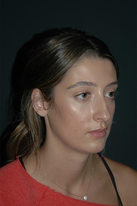 Rhinoplasty Before & After