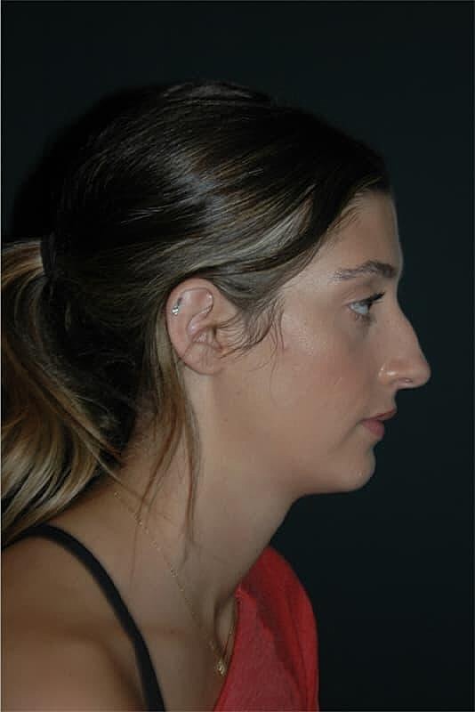 Rhinoplasty Before & After