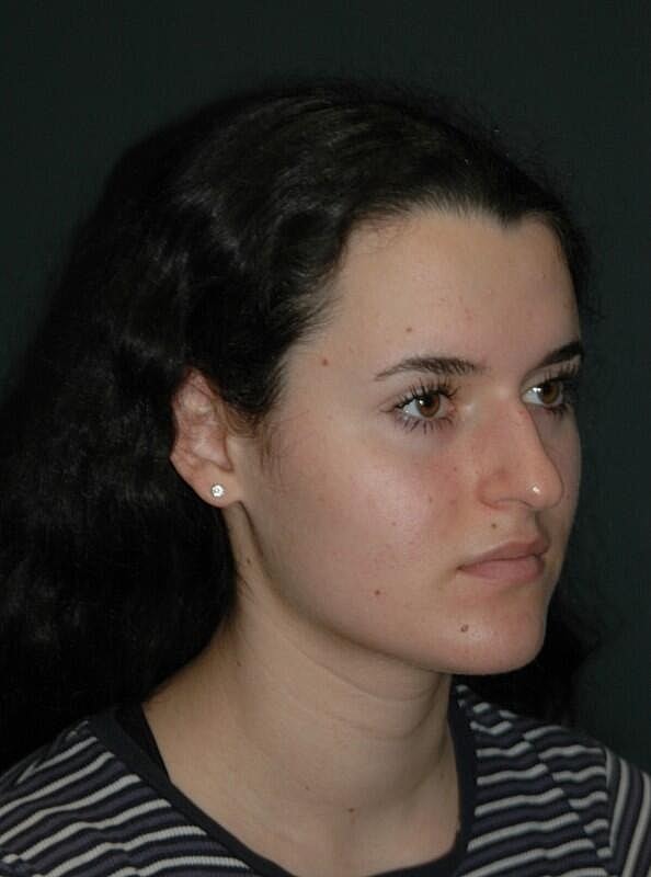 Rhinoplasty Before & After