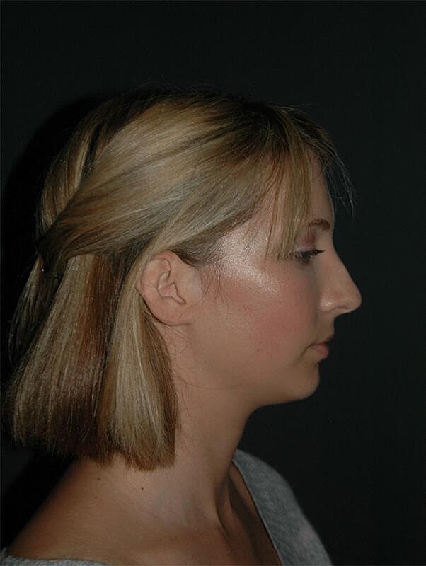Rhinoplasty Before & After