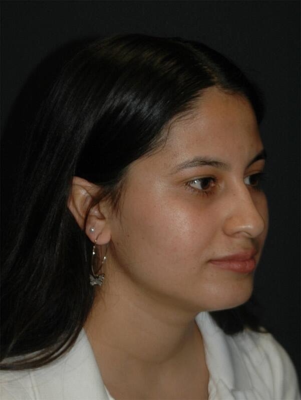 Rhinoplasty Before & After