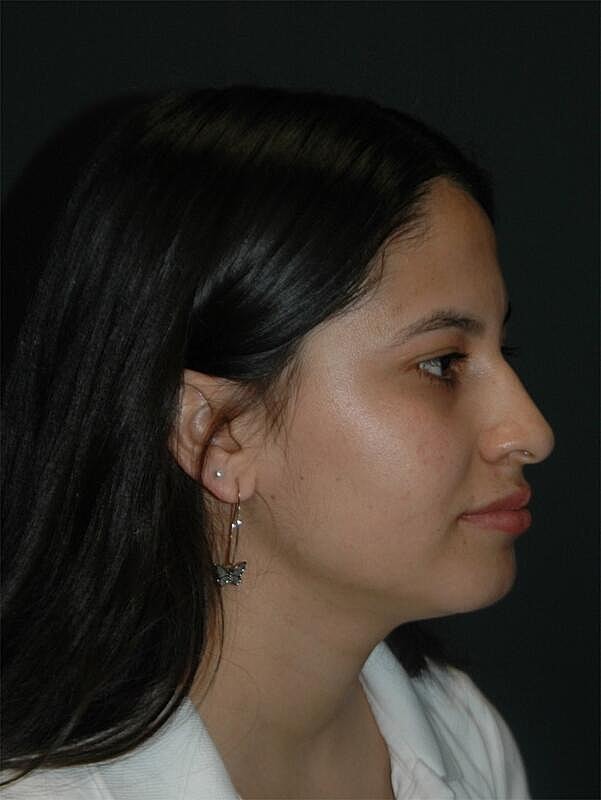 Rhinoplasty Before & After