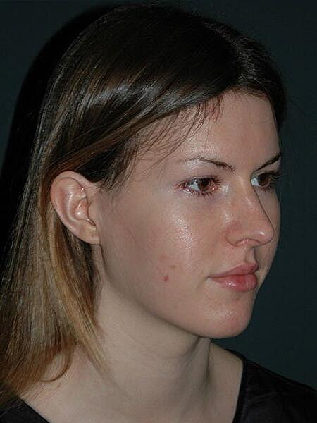 Rhinoplasty Before & After