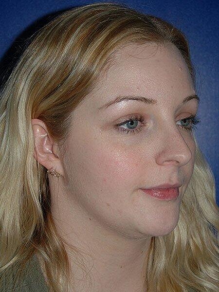 Rhinoplasty Before & After