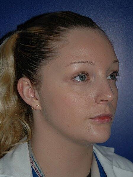 Rhinoplasty Before & After