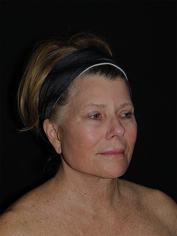 Brow lift Before & After