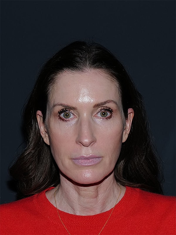 Brow lift Before & After