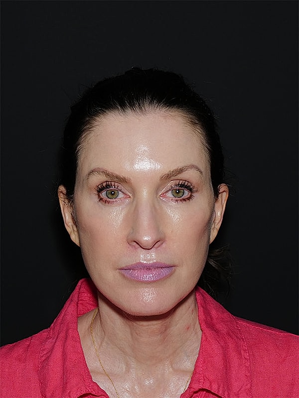Brow lift Before & After