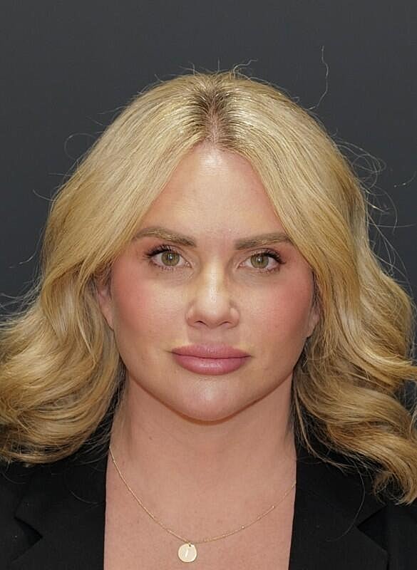 Brow Lift Before & After