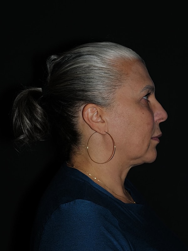 Brow Lift Before & After