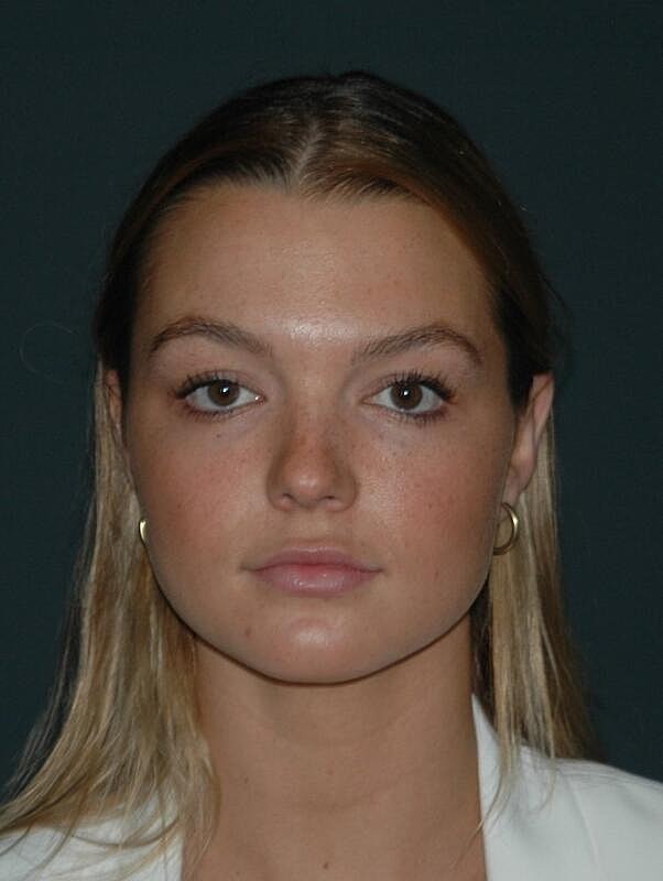 Lip Augmentation Before & After