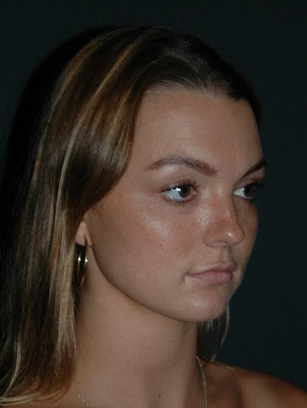 Lip Augmentation Before & After