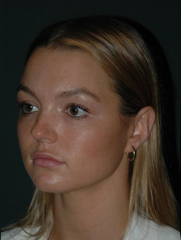 Lip Augmentation Before & After
