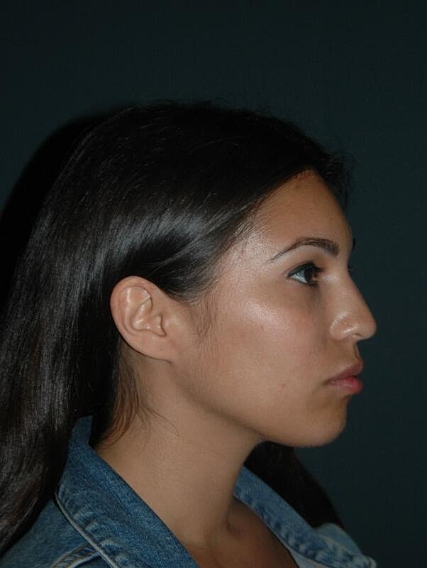 Lip Augmentation Before & After