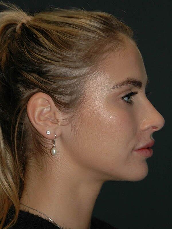 Lip Augmentation Before & After