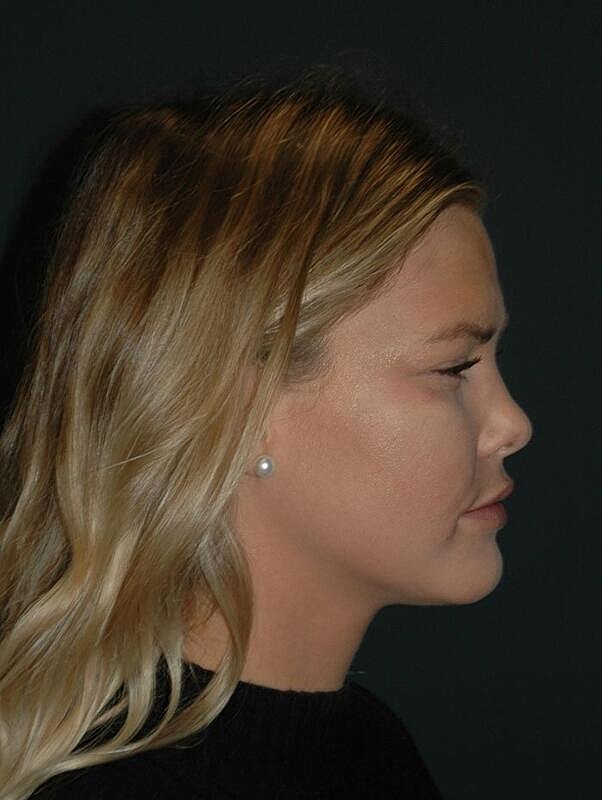 Lip Augmentation Before & After