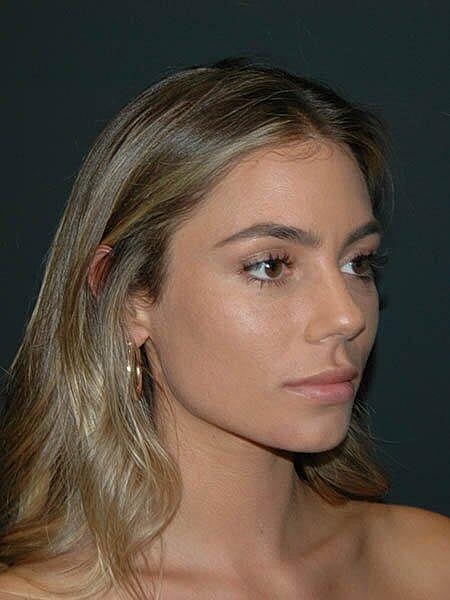 Lip Augmentation Before & After