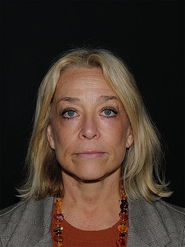 Blepharoplasty Before & After