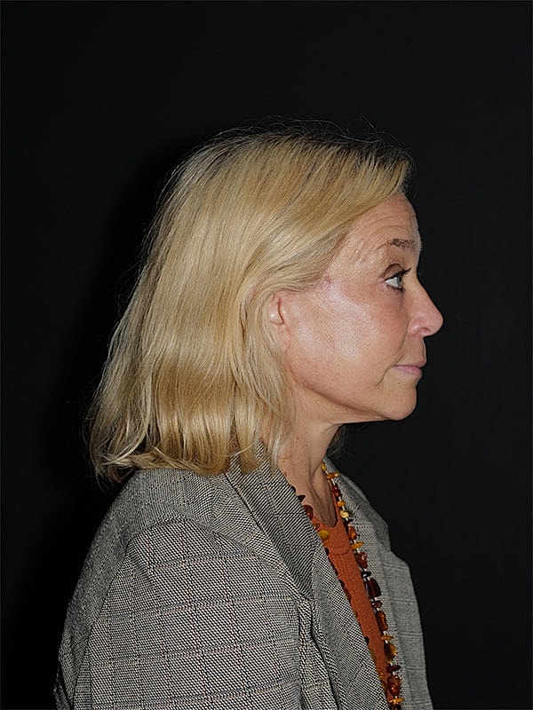 Blepharoplasty Before & After