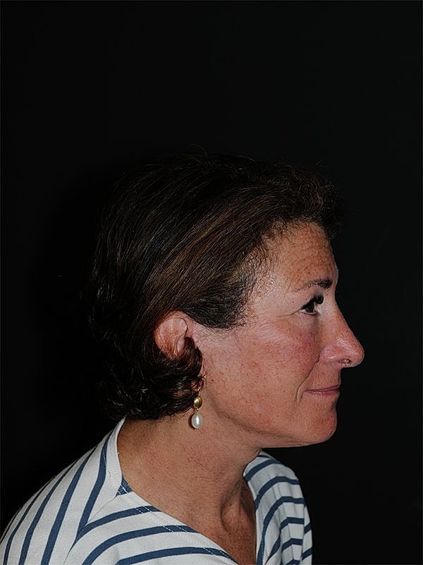 Blepharoplasty Before & After