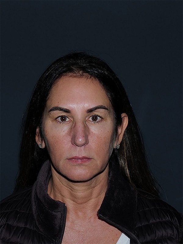 Blepharoplasty Before & After