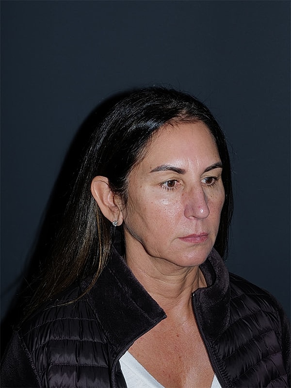 Blepharoplasty Before & After