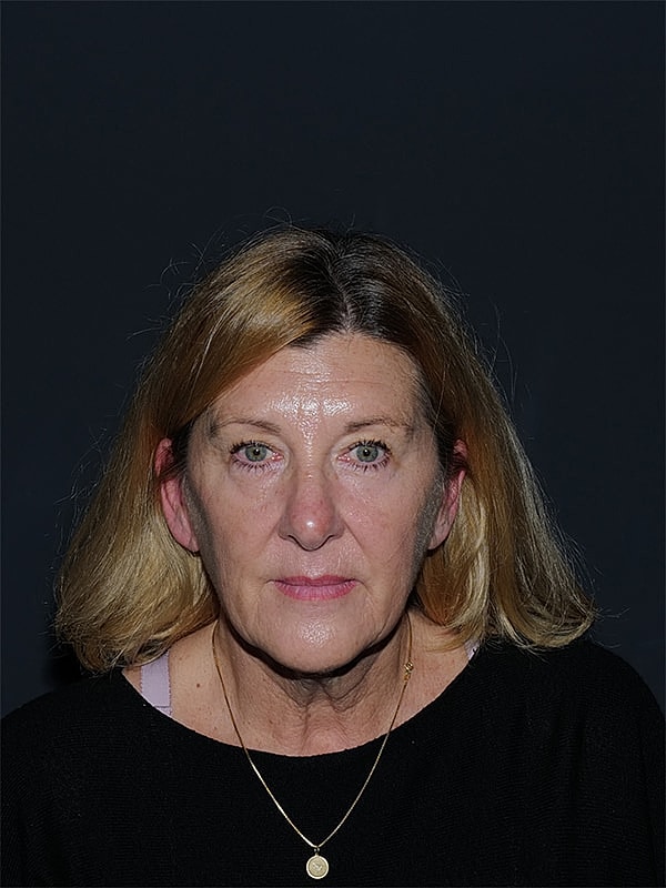 Blepharoplasty Before & After