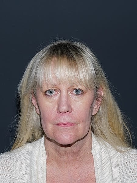 Blepharoplasty Before & After