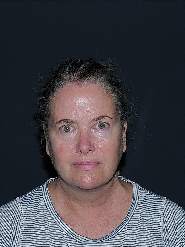 Blepharoplasty Before & After