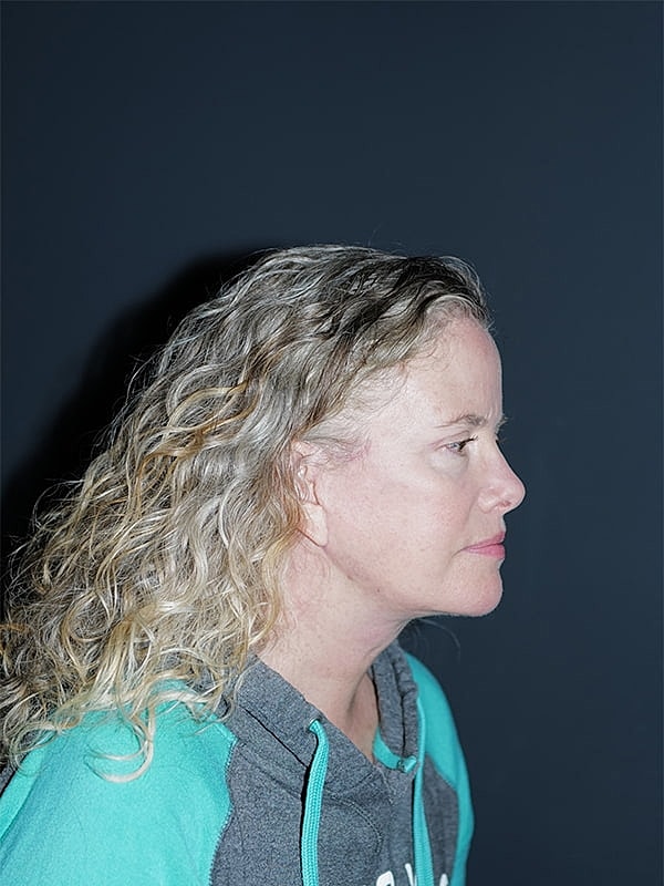 Blepharoplasty Before & After
