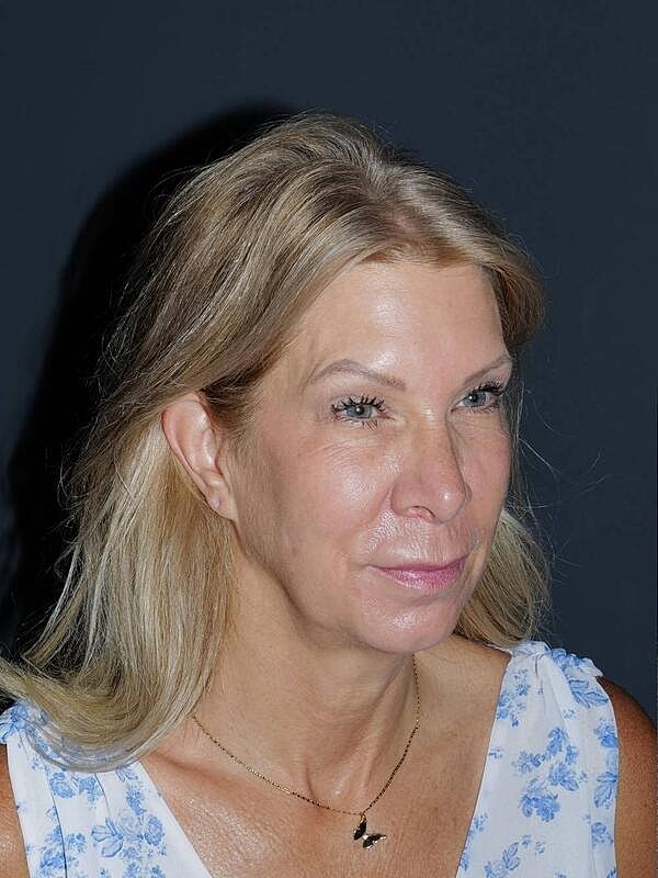 Blepharoplasty Before & After