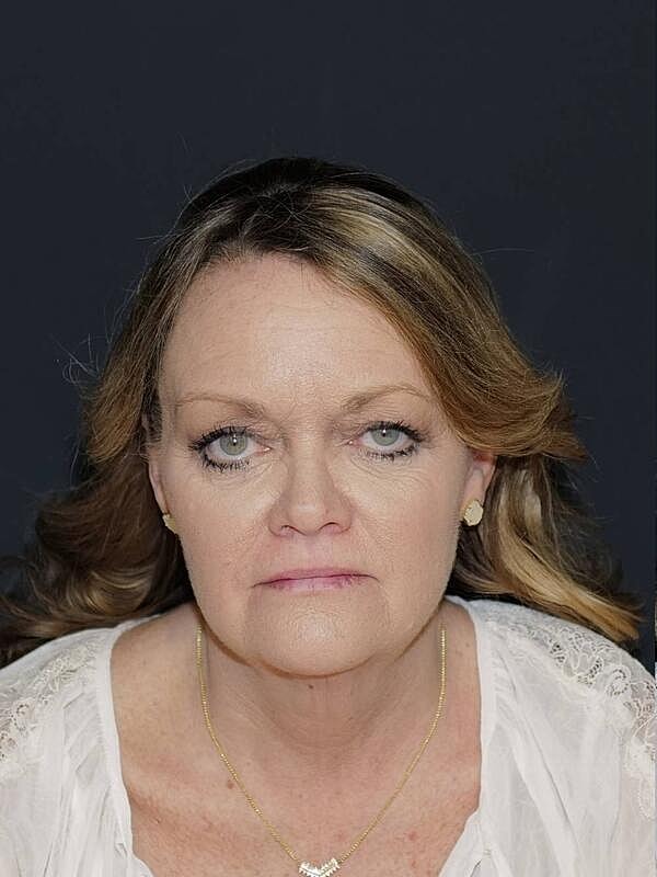 Blepharoplasty Before & After