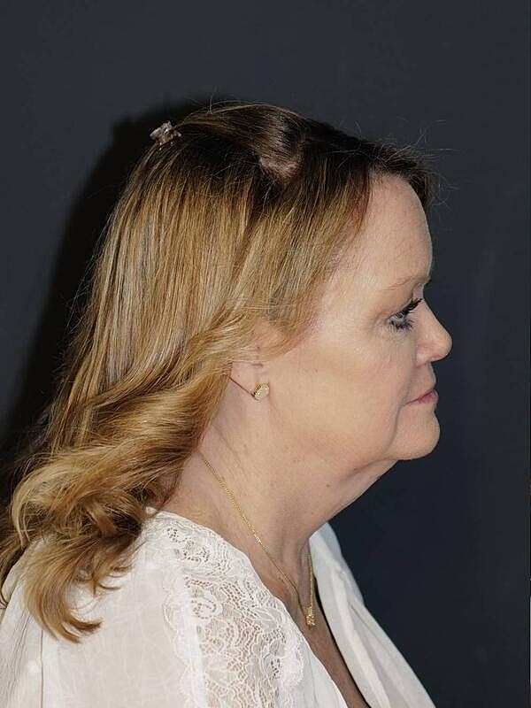 Blepharoplasty Before & After