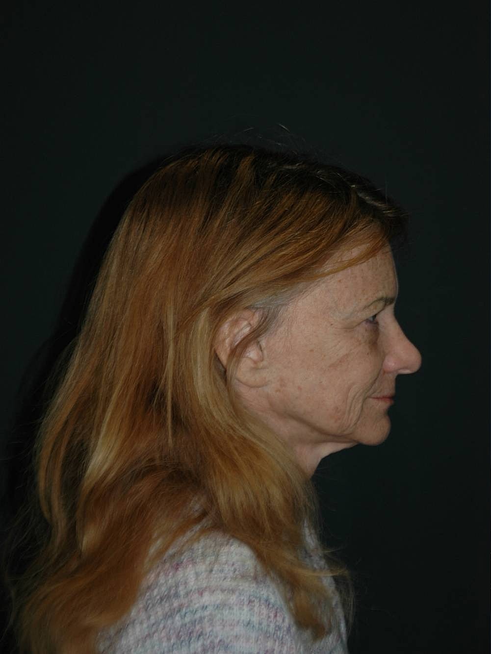 Blepharoplasty Before & After