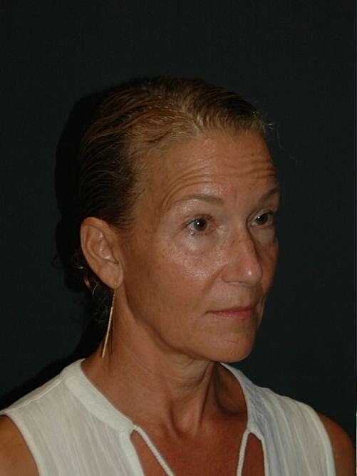 Blepharoplasty Before & After