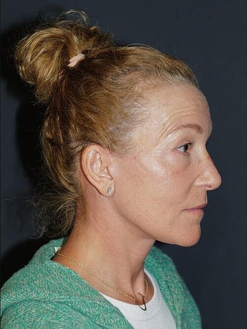 Blepharoplasty Before & After