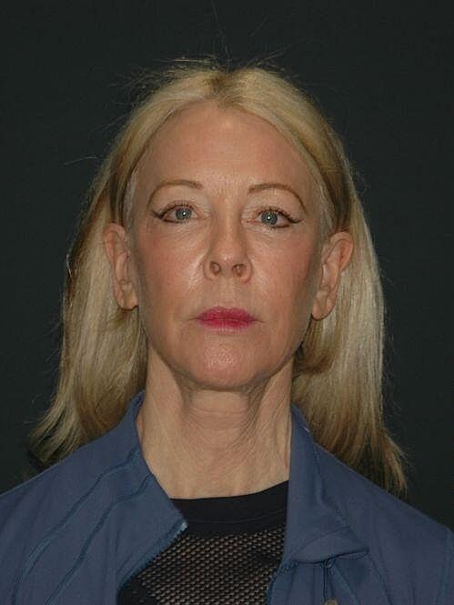 Blepharoplasty Before & After