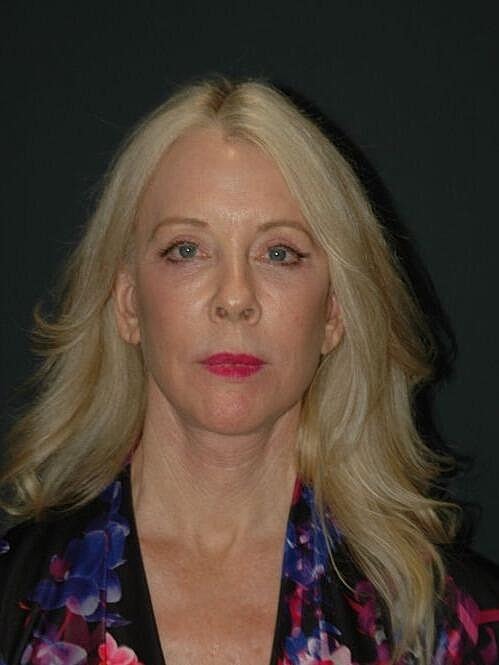 Blepharoplasty Before & After