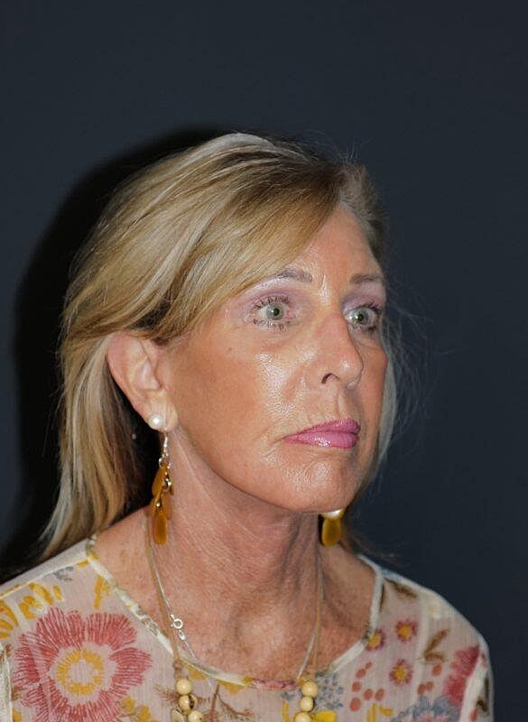 Blepharoplasty Before & After